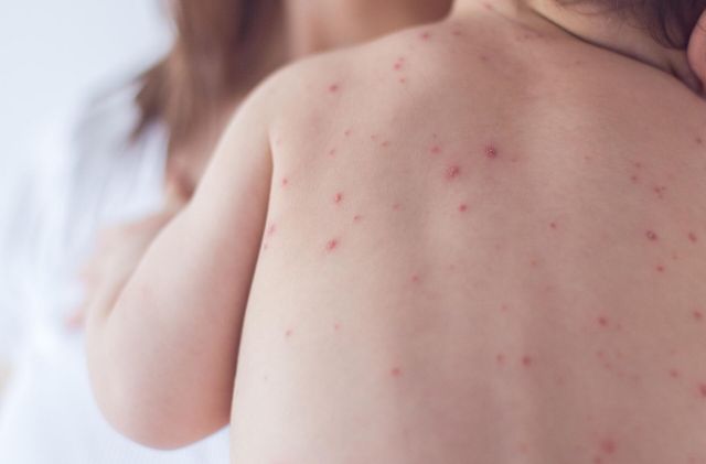 Внутреннее обучение сотрудников НИЦ. Корь. Эпидемиология, современные возможности профилактики, диагностики и лечения