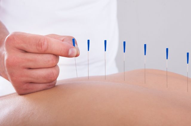 Рефлексотерапия